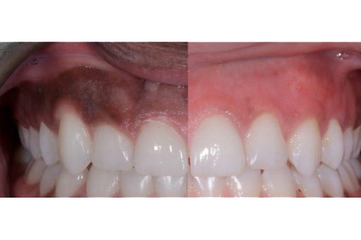 Depigmentation of gums